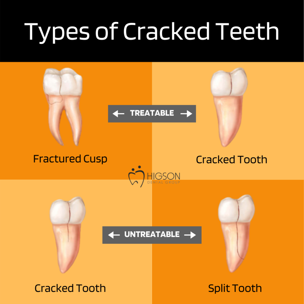 How To Classify the 5 Types of Cracked Teeth - Spear Education