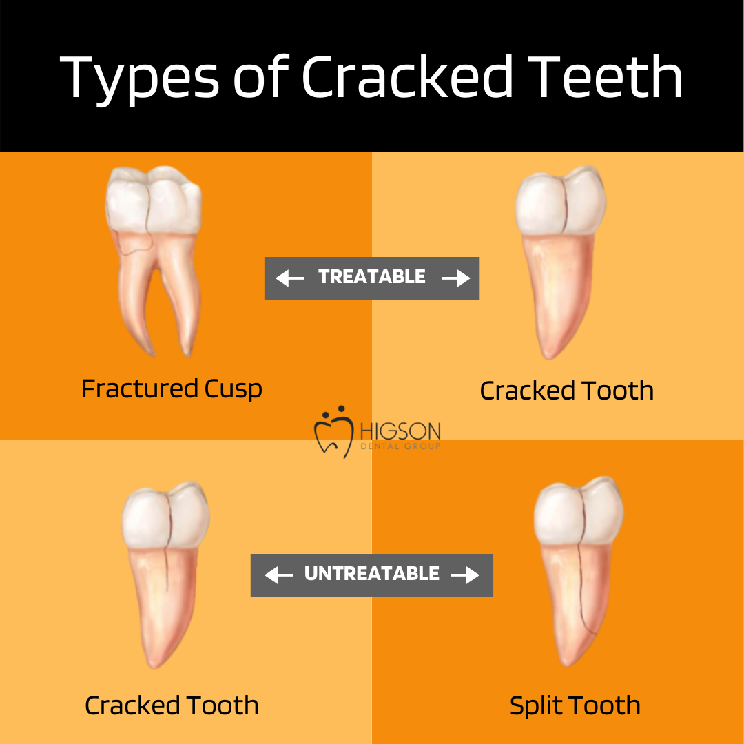 Cracked Tooth Repair Common Causes And Fixes For Cracked Teeth 